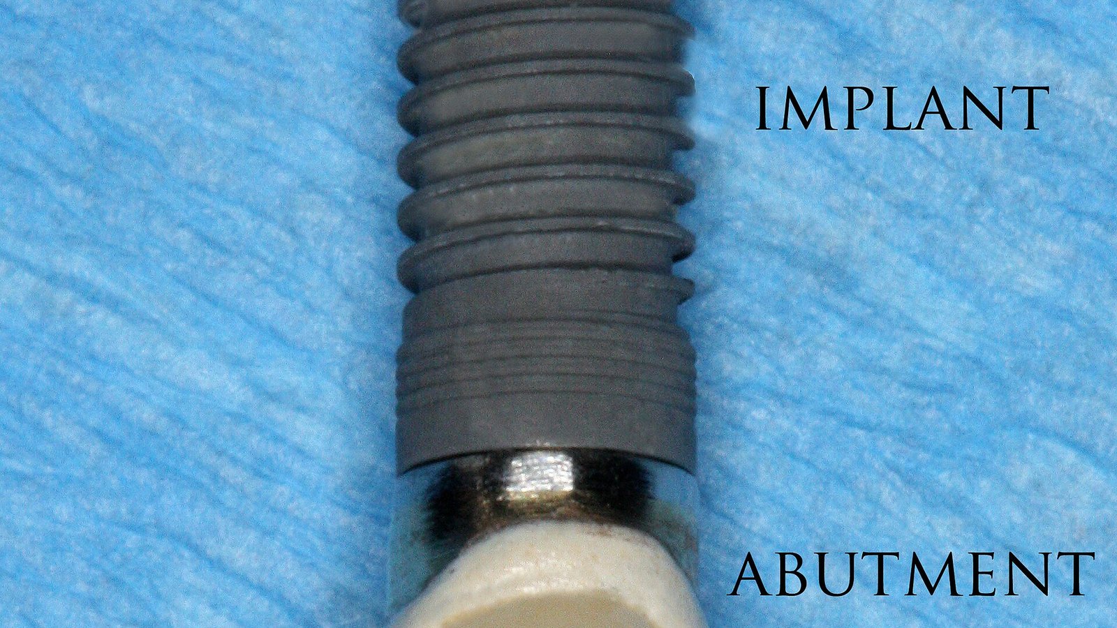 Dental Implants