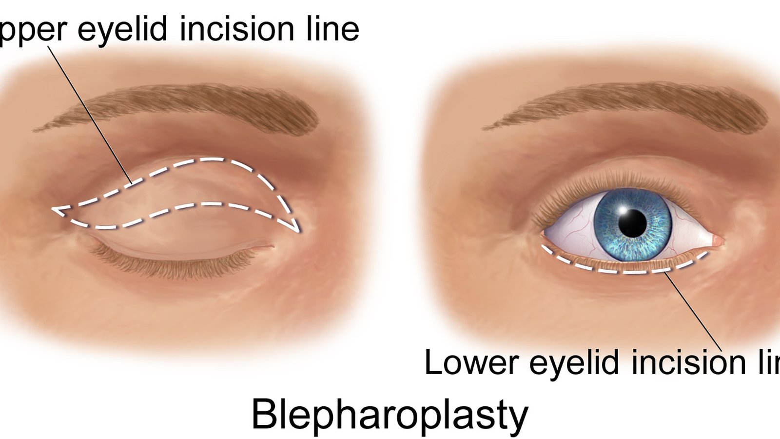 Eyelid Surgery (Blepharoplasty)