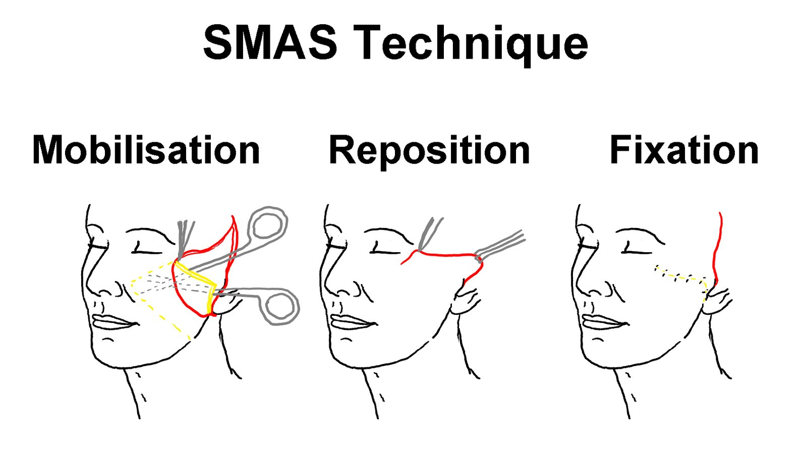 Facelift