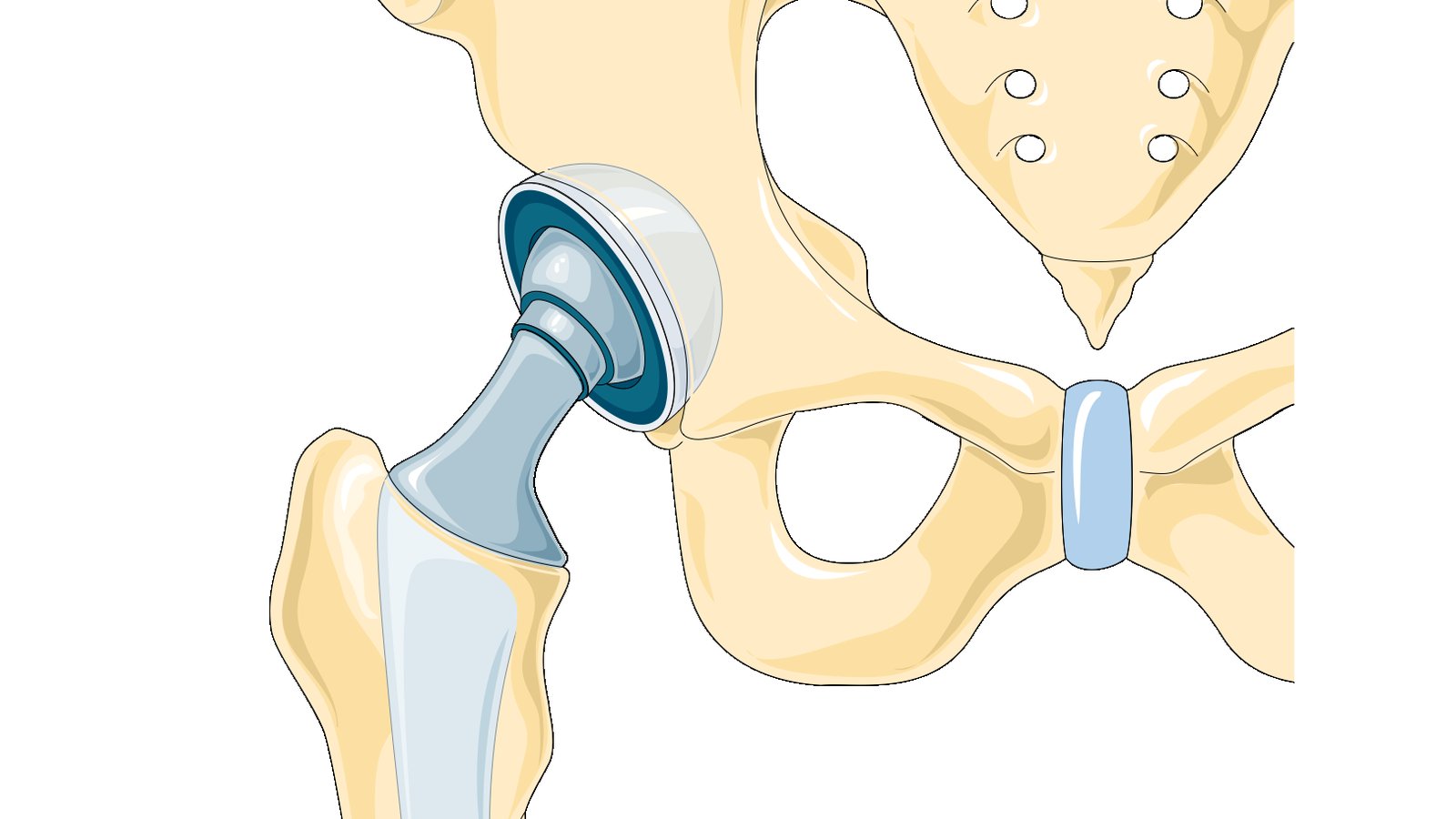 Hip Replacement