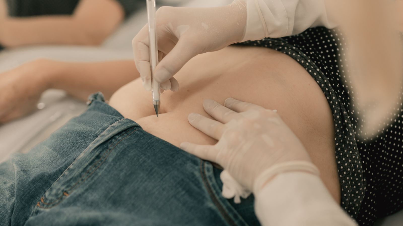 Liposuction