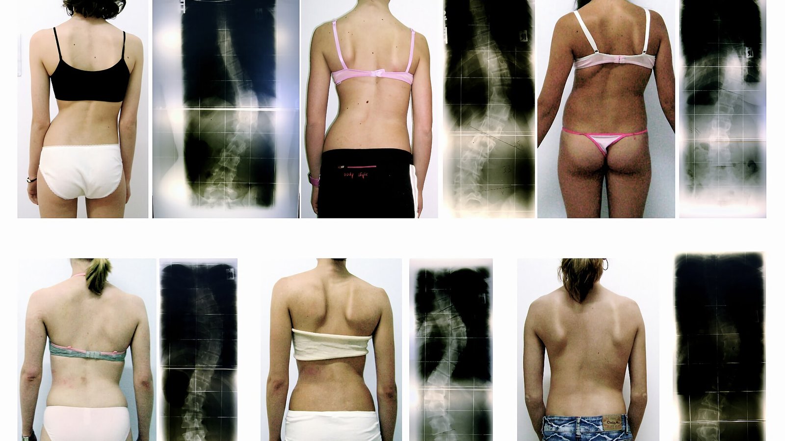 Scoliosis Surgery / Robotic Scoliosis