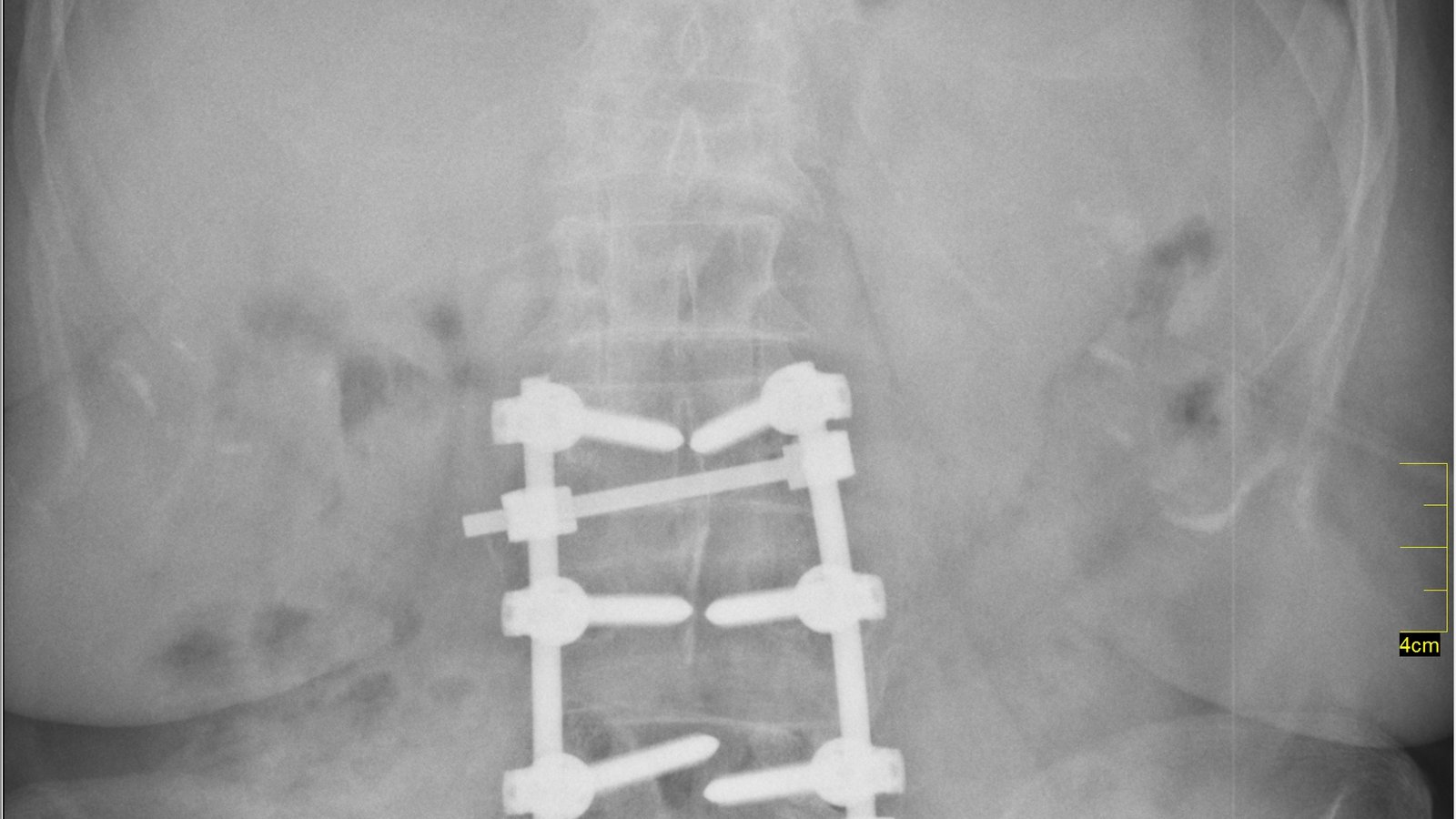 Spinal Fusion Surgery