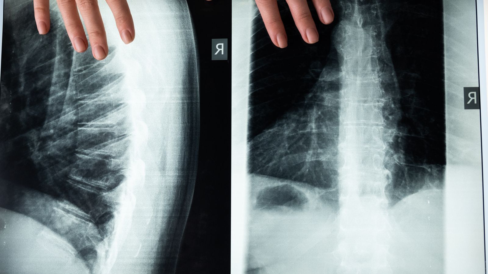 Spinal Fusion Surgery