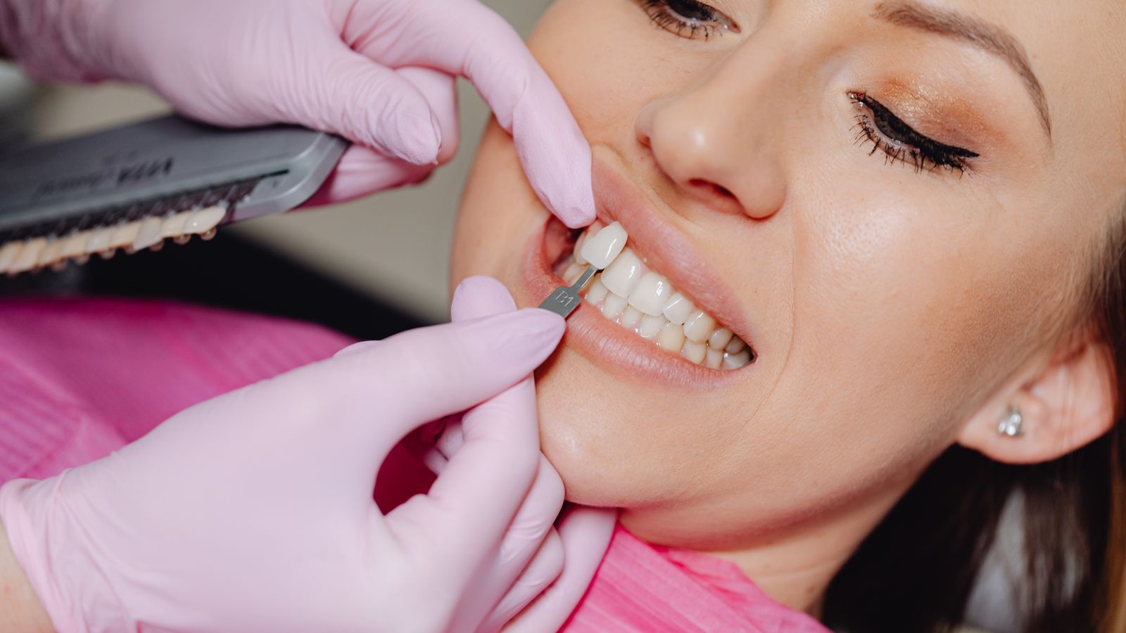 Veneers